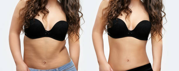 Weight loss Weight loss plastic surgery photos stock pictures, royalty-free photos & images