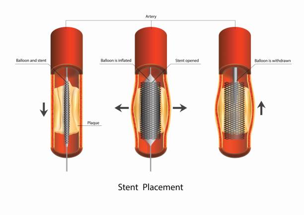 ilustraciones, imágenes clip art, dibujos animados e iconos de stock de colocación de un stent - angioplasty