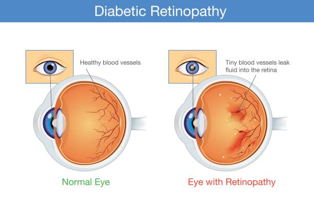 Anatomy of normal eye and Diabetic retinopathy. Anatomy of normal eye and Diabetic retinopathy in people who have diabetes. Illustration about health and eyesight. cornea stock illustrations