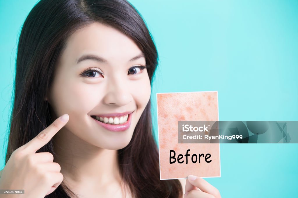 beauty skincare woman beauty skincare woman take picture and point her face before and after Acne Stock Photo