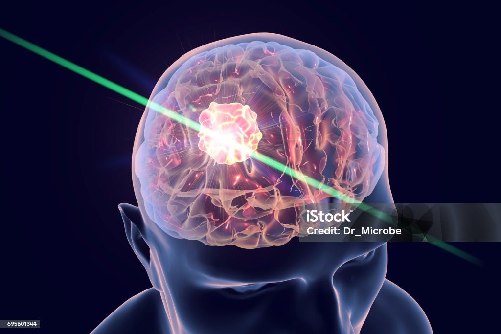 Destruction of brain tumor Destruction of brain tumor by laser, 3D illustration. Conceptual image for brain cancer treatment Laser Stock Photo