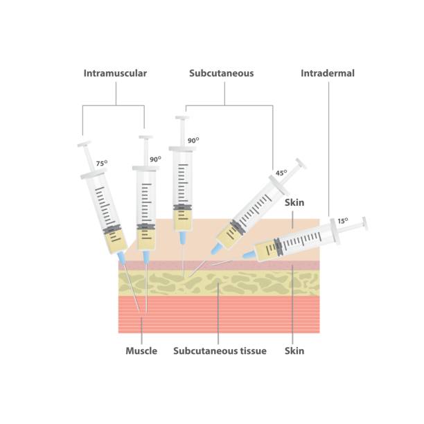 Insulin Injection Process 820+ Insulin Injection Technique Stock Illustrations, Royalty-Free ...