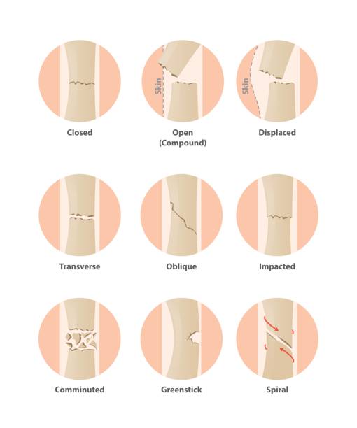 흰색 바탕에 동그라미 그림 벡터에서 골절의 유형입니다. 건강 개념입니다. - fracture stock illustrations