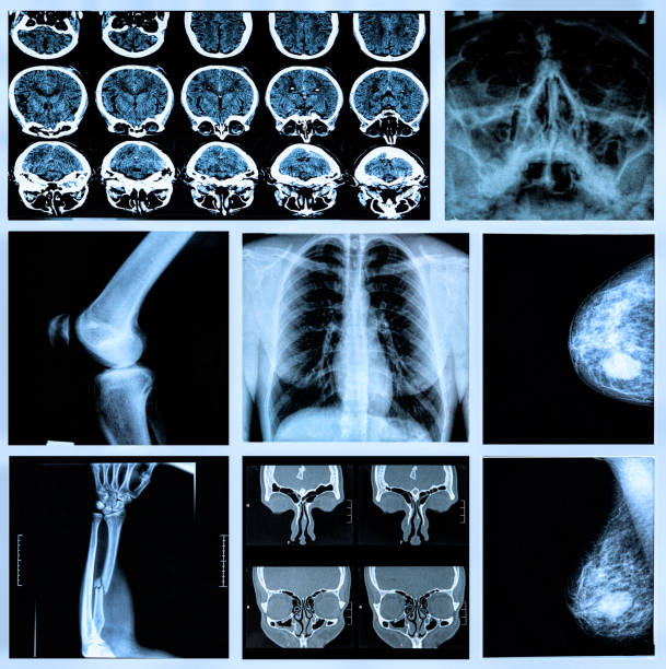 menschlicher knochen - mammogram mri scan breast breast examination stock-fotos und bilder