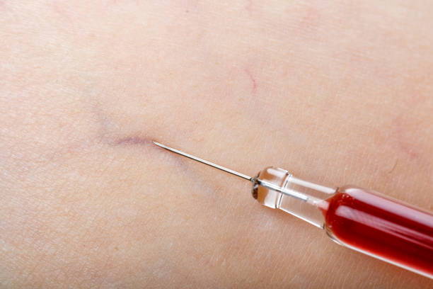 istock Injection treatment on human skin 696414742