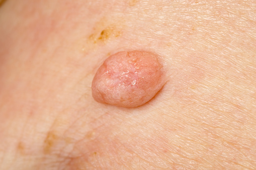 Close up photo of huge wart on human skin