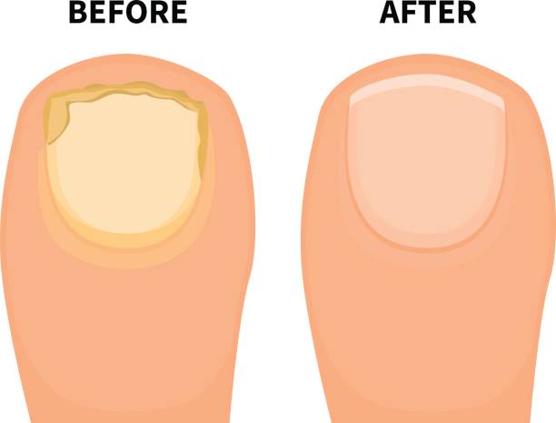 Vector toe nail before and after fungal disease Vector illustration of a big toe before and after a fungal disease. Isolated white background. Sick fungus nail and healthy beautiful nail. Flat style. tinea stock illustrations