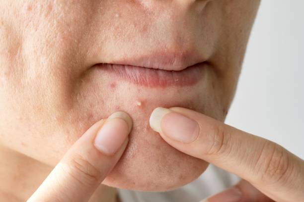 Acne pus, Close up photo of acne prone skin, Woman squeezing her pimple, Removing pimple from her face. stock photo