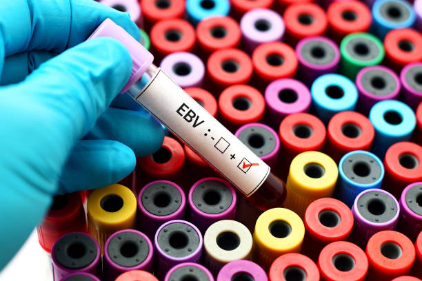 Epstein-Barr positive Blood sample positive with Epstein-Barr virus (EBV) epstein barr virus photos stock pictures, royalty-free photos & images