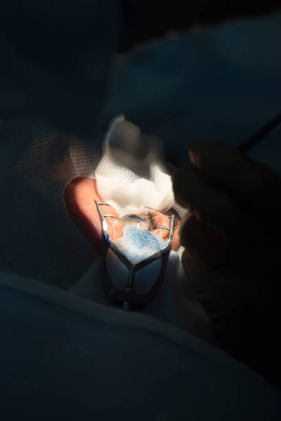 fakoemulsyfikacja, zniszczenie nieprzezroczystej soczewki oka za pomocą ultradźwięków. - nerve cell healthcare and medicine research human hand zdjęcia i obrazy z banku zdjęć