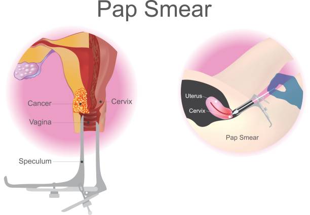 ilustraciones, imágenes clip art, dibujos animados e iconos de stock de prueba de papanicolaou es un procedimiento de cribado para cáncer de cuello uterino. diseño vectorial. - espéculo