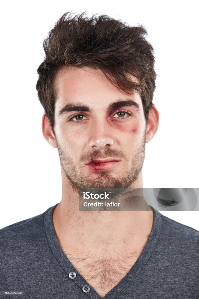 He got more than just his ego bruised Studio portrait of a young man with scratches on his face against a white background Human Face Stock Photo