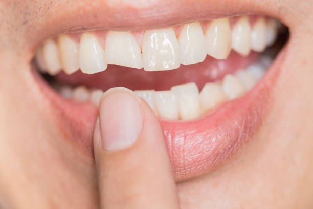 lelijke glimlach tandheelkundig probleem. verwondingen van de tanden of tanden breken in male. trauma en zenuwletsel van gewonde tand, de tanden van de permanente schade. - teeth stockfoto's en -beelden