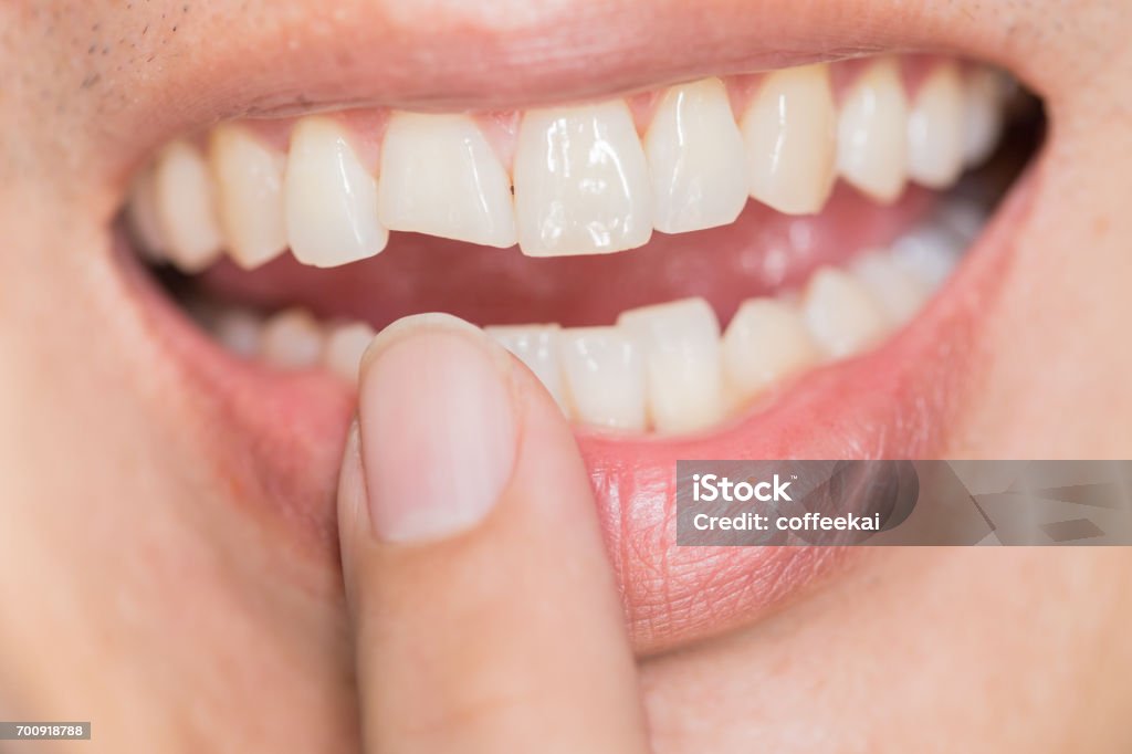 fula leende tand problem. Tänder skador eller tänderna bryta i Male. Trauma och nervskada av skadade tand, permanenta tänder skada. - Royaltyfri Tänder Bildbanksbilder