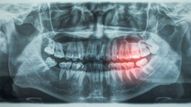 istock Panoramic dental X-Ray, with red painful area 701016162