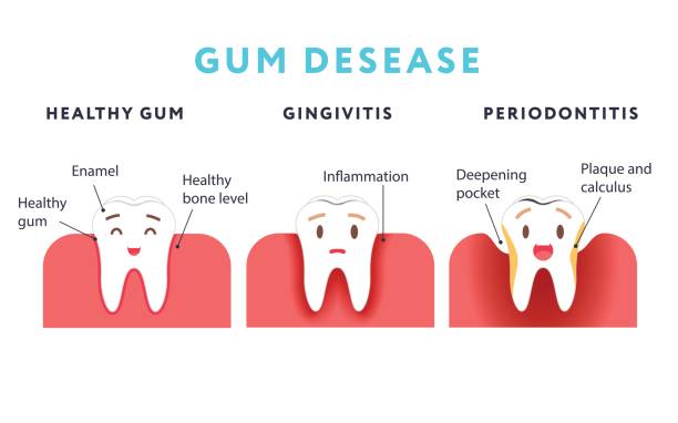 krok choroby dziąseł. zdrowe zapalenie zębów i dziąseł.. ładny projekt kreskówki, ilustracja odizolowana na niebieskim tle. - human teeth gums dental hygiene inflammation stock illustrations