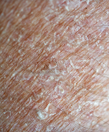 Senior's very dry flaking skin close-up- of the section of the arm.