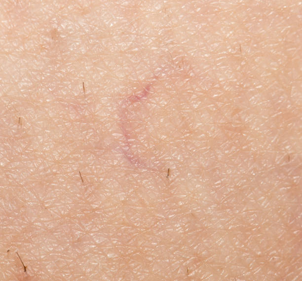 istock veins on the skin. close 701129206
