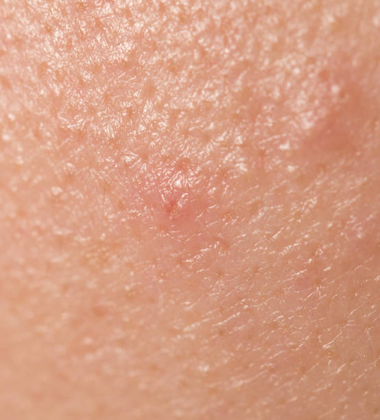 istock pimples on the skin. close 701138660