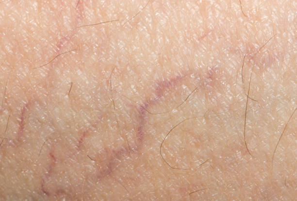 istock veins on the skin. close 701145388