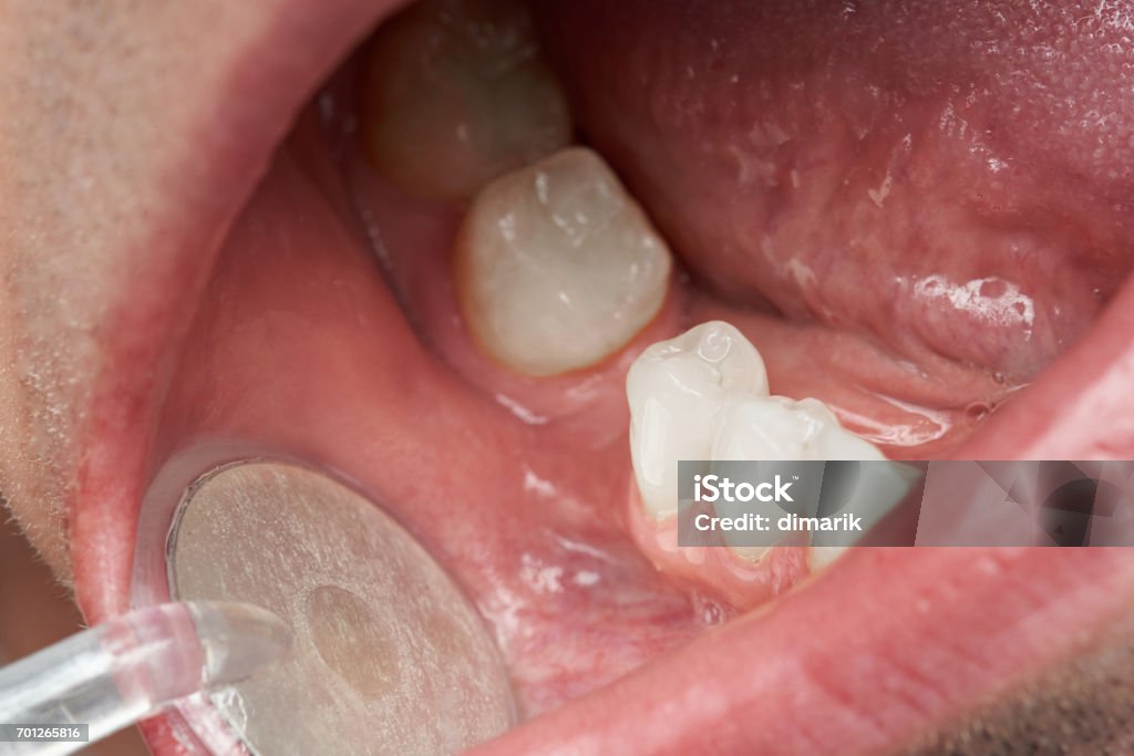 Dentist checking patient mouth Dentist checking patient mouth close-up. Dentist theme concept Teeth Stock Photo