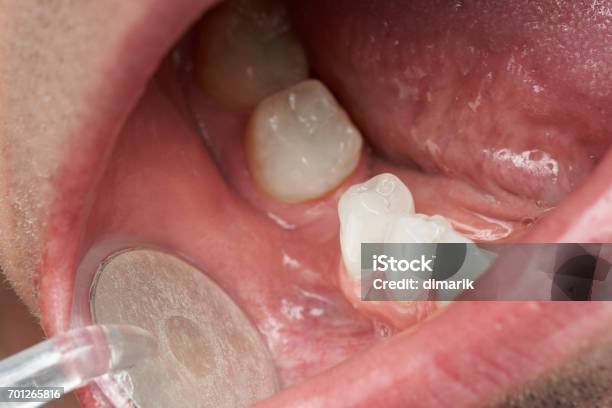 Dentist Checking Patient Mouth Stock Photo - Download Image Now - Teeth, Beauty, Men