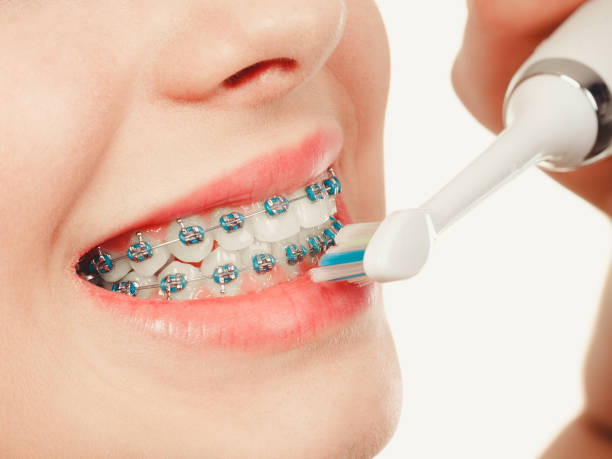 istock Woman smiling cleaning teeth with braces 800287188