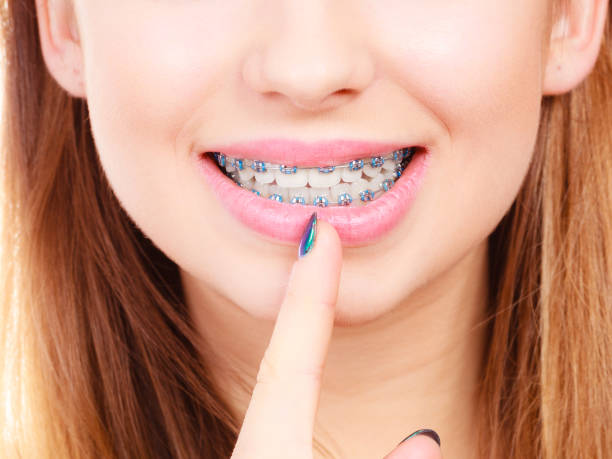 istock Woman showing her teeth with braces 800290012