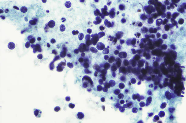 micrograh von kleinzelligem lungenkrebs - wissenschaftliche mikroskopische aufnahme stock-fotos und bilder