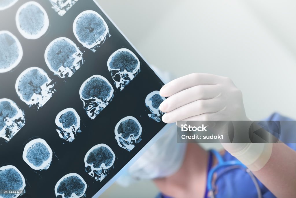 Medical experts studied the EEG condition of the patient Alzheimer's Disease Stock Photo