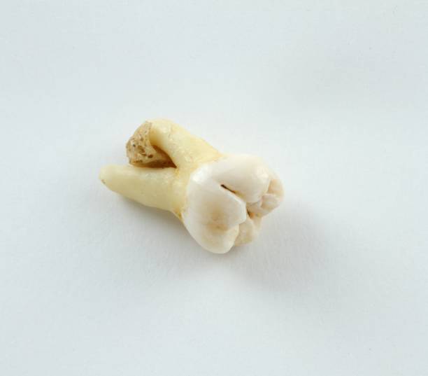 istock Remove eighth lower tooth with a piece of bone tissue on paper. Wisdom tooth 801566572