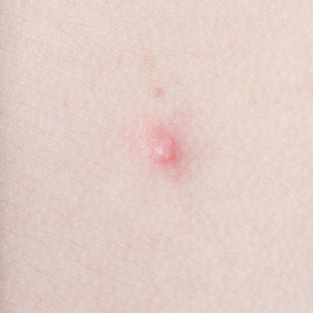 istock Acne on human skin closeup 801674528