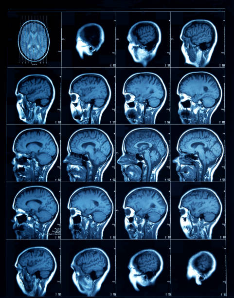 ct scan d’un humain adulte - tronc cérébral photos et images de collection