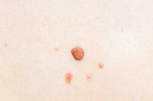 istock Woman with birthmark on her back, skin tags removal 802279066