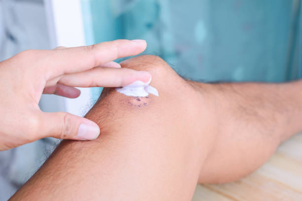 istock Treatment for scar on leg. 802505008