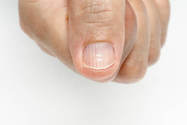 White spots and Vertical ridges on the fingernails symptoms White spots and Vertical ridges on the fingernails symptoms deficiency vitamins and minerals mountain ridge stock pictures, royalty-free photos & images