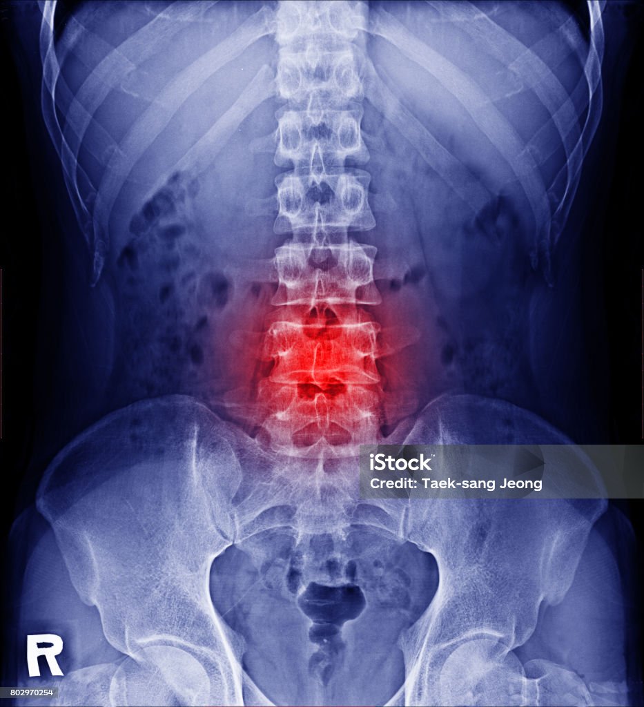 Film x-ray intervertebral lumbar spine  and pelvis Film x-ray intervertebral lumbar spine  and pelvis of Man Back Stock Photo