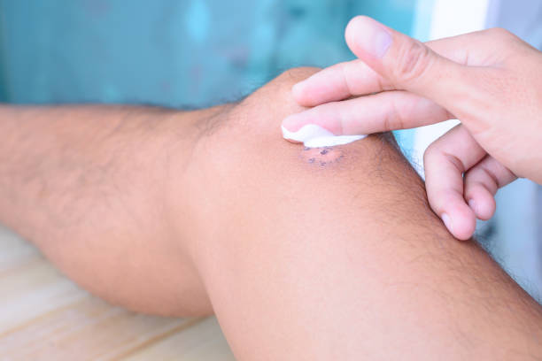 istock Treatment for scar on leg. 802991252