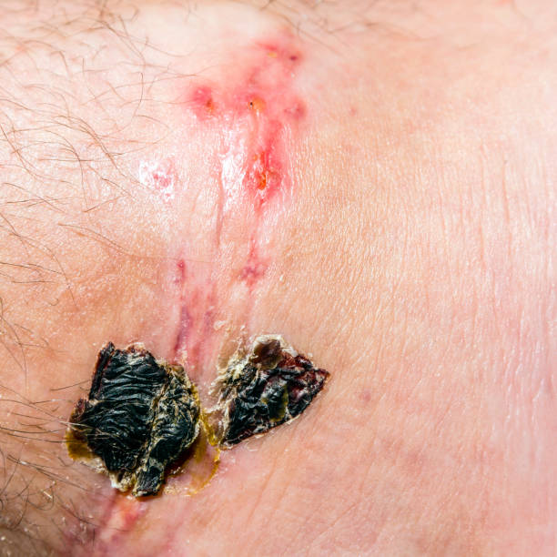 Scar and scab (eschar) on the leg. Scar and eschar (scab) on leg resulting from surgical suture a wound in a hospital. eschar stock pictures, royalty-free photos & images