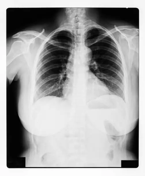 Photo of black and white X-ray Image of a human chest for a medical diagnosis