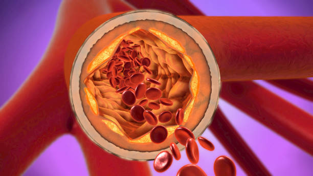 3d illustration of a precipitated and narrowing blood vessels or arteriosclerosis - bloodstream imagens e fotografias de stock