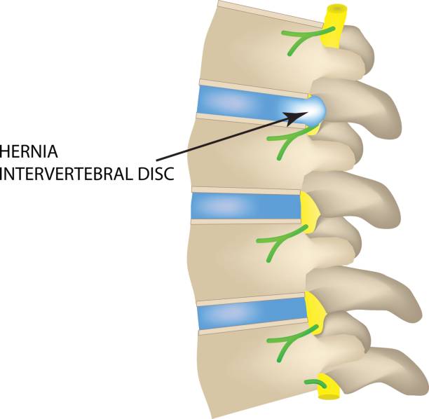 przepuklina krążka międzykręgowego. ilustracja wektorowa - vertebrate stock illustrations