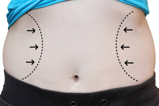 body contouring