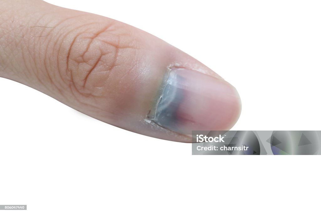 injured finger and bruised nail isolated injured finger and bruised nail Blood Stock Photo