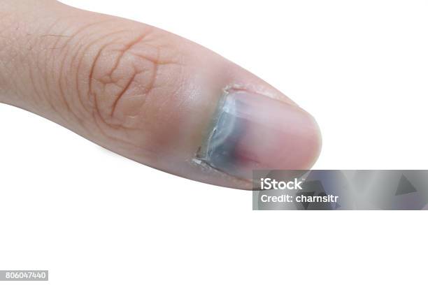 Injured Finger And Bruised Nail Stock Photo - Download Image Now - Blood, Bruise, Finger