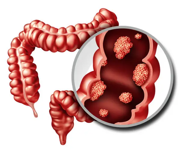 Colon or colorectal cancer concept as a medical illustration of a large intestine with a malignant tumor growth disease of the digestive system as a 3D illustration.