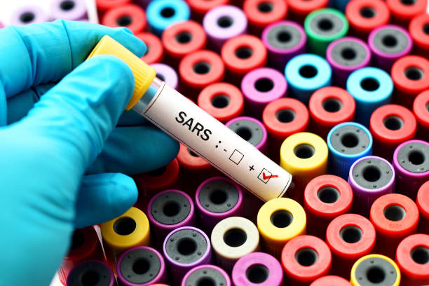 SARS positive Blood sample positive with severe acute respiratory syndrome (SARS) severe acute respiratory syndrome stock pictures, royalty-free photos & images