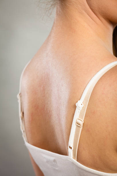 istock woman scratching her itchy back with allergy rash 807780068