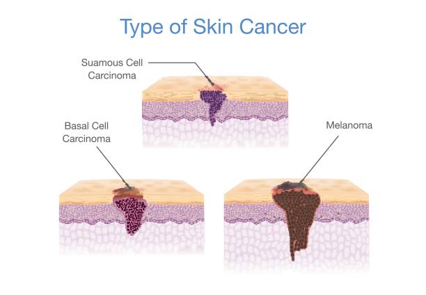 ilustrações, clipart, desenhos animados e ícones de tipo de câncer de pele em estilo 3d vector. - cancer de pele