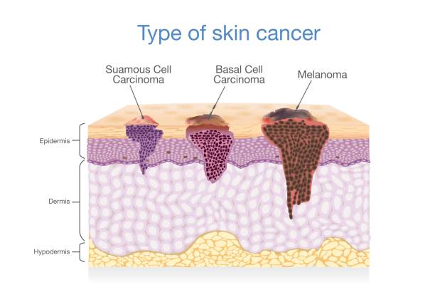 ilustrações, clipart, desenhos animados e ícones de camada de pele tem 3 tipo de câncer em um. - cancer de pele